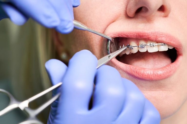 Transform Your Smile with Damon Fixed Braces Near Toronto damon fixed braces near me