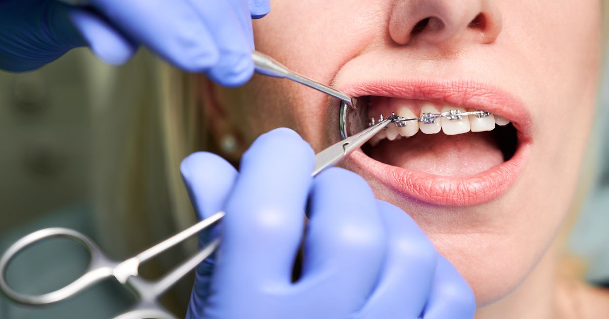 Transform Your Smile with Damon Fixed Braces Near Toronto damon fixed braces near me