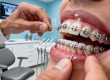 how do pitts 21 braces work