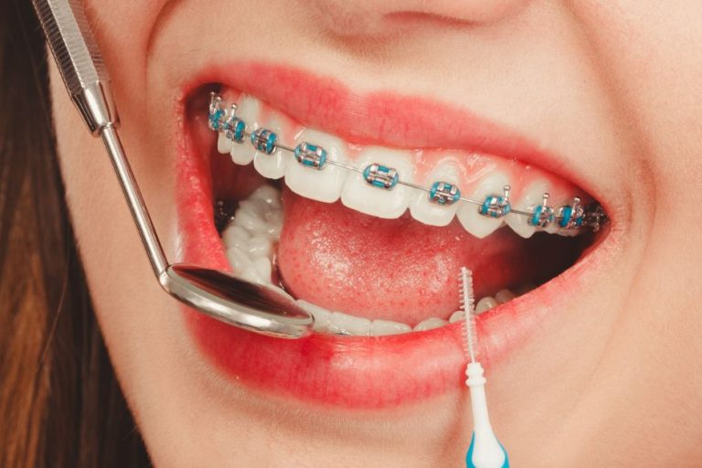 can pitts 21 braces treat severe crowding