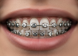 what makes pitts 21 braces different from damon braces