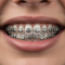 what makes pitts 21 braces different from damon braces