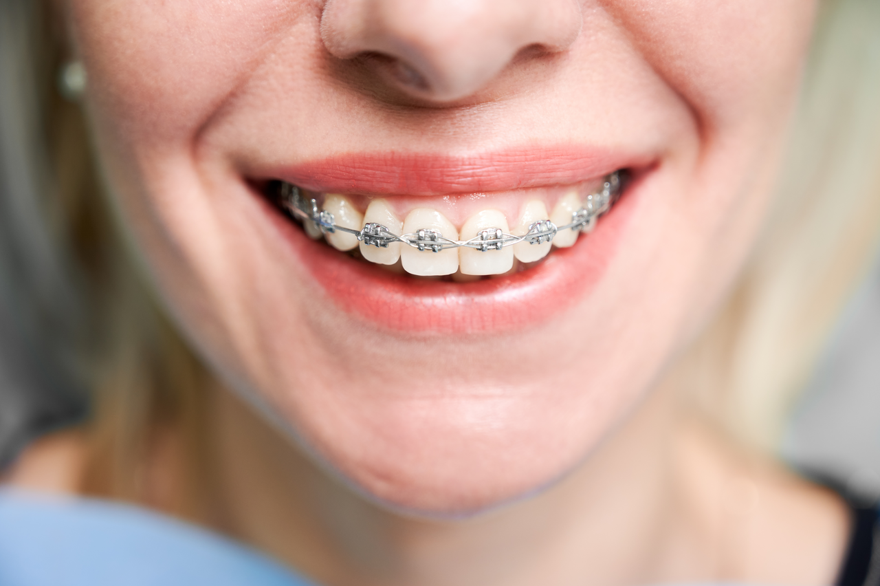Teeth with braces
