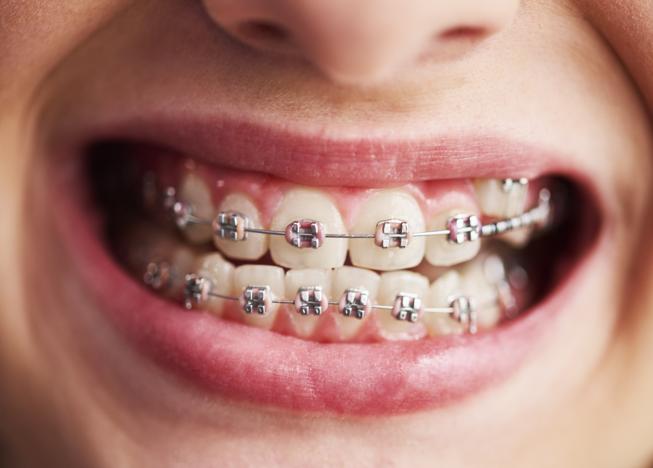 child-teeth-with-braces
