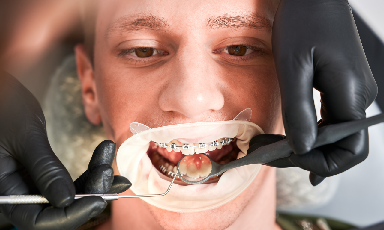 Straightening Teeth