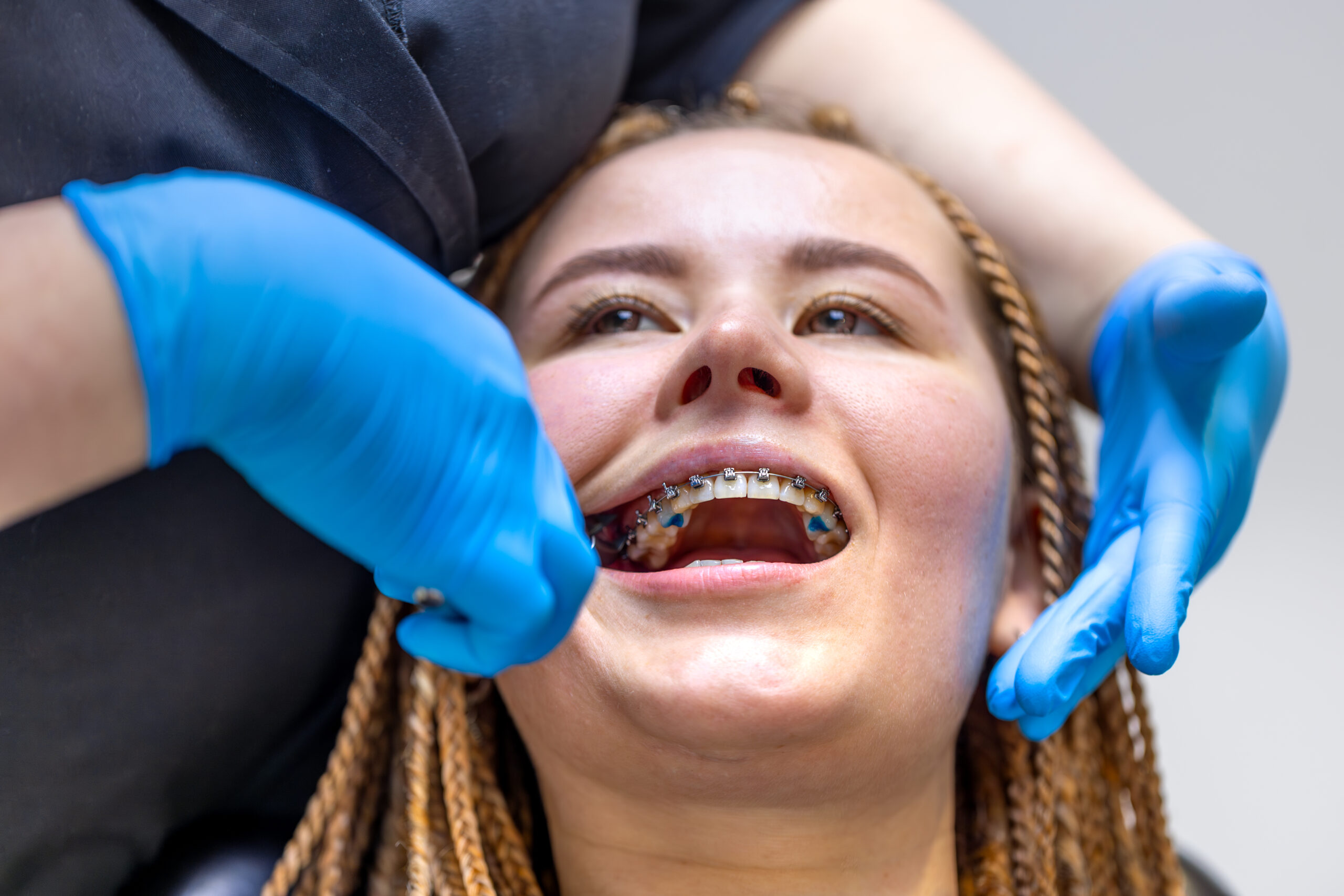 Dental procedure for installing braces close up. Dentistry. Braces on the teeth.
